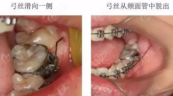 牙套末端的弓丝滑脱