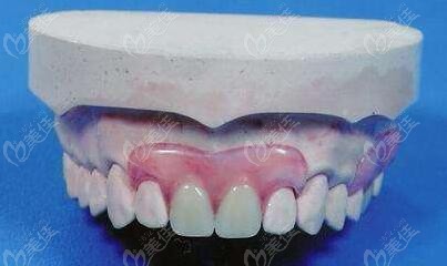 门牙拔后临时假牙照片图片
