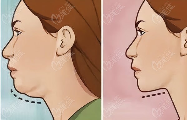 双下巴和下颌缘吸脂前后对比照片