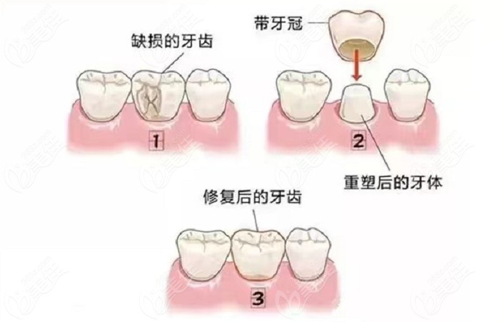 单颗牙进行全瓷牙修复的方法