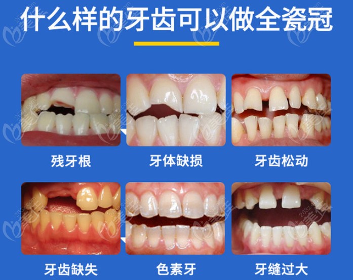 以下牙齿情况都可以使用全瓷冠进行修复