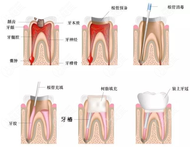 乳牙根管治疗步骤图解图片