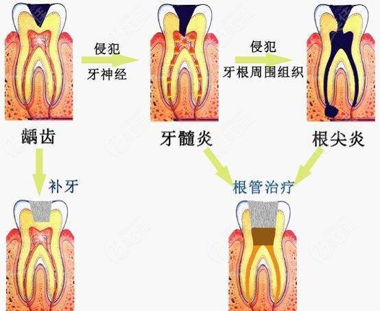 深度龋齿会导致牙髓炎及根尖炎