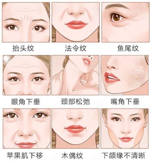 拉皮手术适合改善的症状