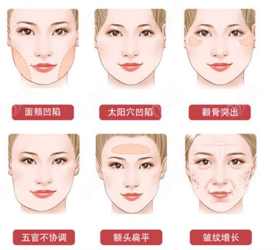 面部脂肪填充适合哪些部位
