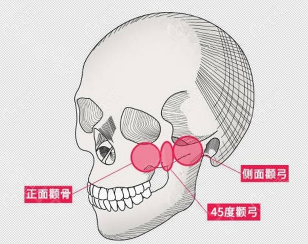 颧骨颧弓45度内推手术