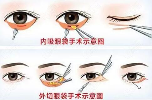 北京内切外切祛眼袋手术示意图解