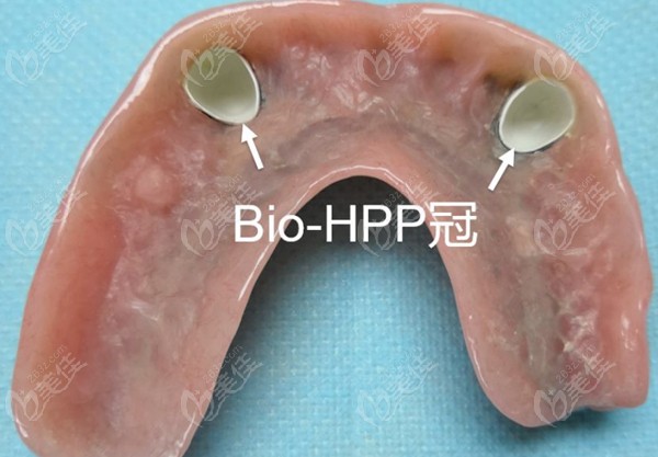 德國hpp活動義齒支架多少錢得從hpp義齒材料來看