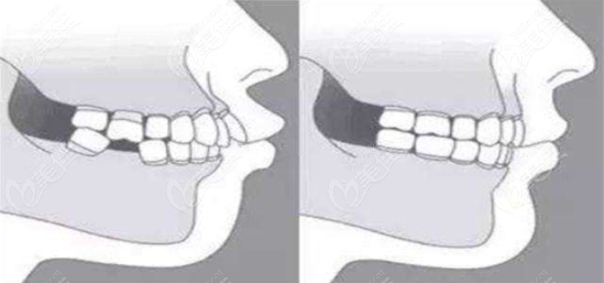 为什么正颌和正畸要一起做