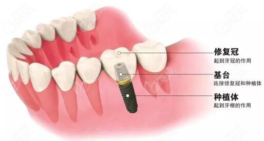 种植牙结构