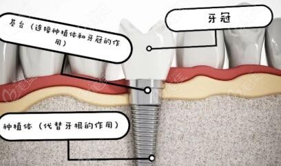 种植牙粘结固位与螺丝固位的区别