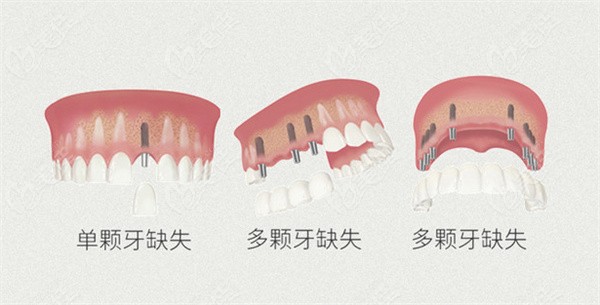 种植牙各类缺失情况的适用