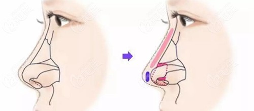 肋软骨鼻综合的材料部位