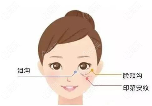 做拉皮手术可以改善印第安纹吗？