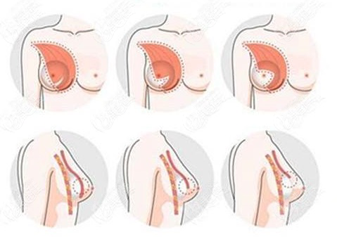 假体隆胸的过程图片