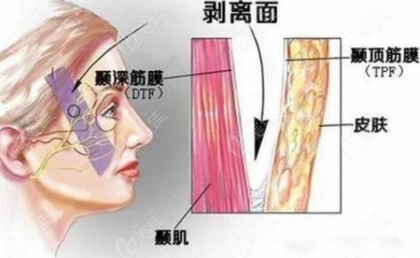 拉皮手术过程剥离