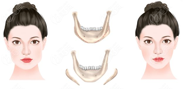 ：长曲线下颌角截骨改善侧面下颌缘曲线