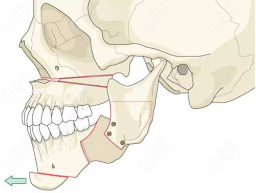正颌手术的过程