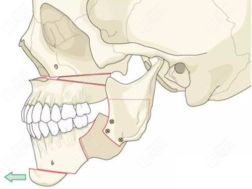 单侧反颌导致的偏颌做正颌手术的过程