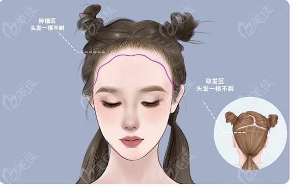 成都首瑞专注女性不剃发植发