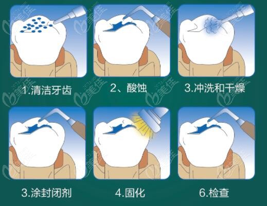 窝沟封闭的过程