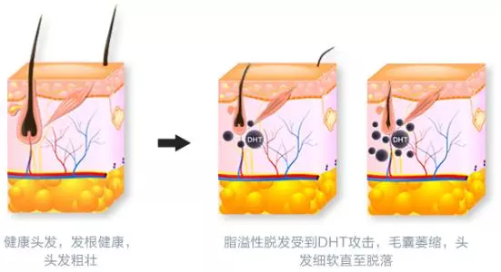 女性脂溢性脱发的原因