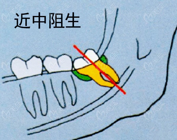 拔掉近中阻生智齒要多少錢