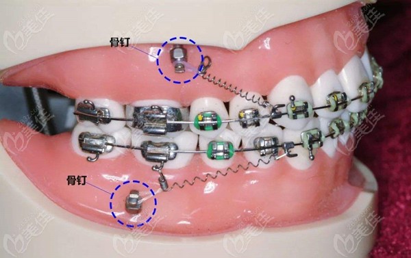什么是牙齿矫正支抗钉