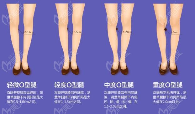 北京o型腿矫正医院可以矫正不同程度o型腿