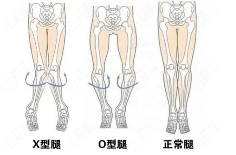 正常腿型和O型腿、x型腿对比图片