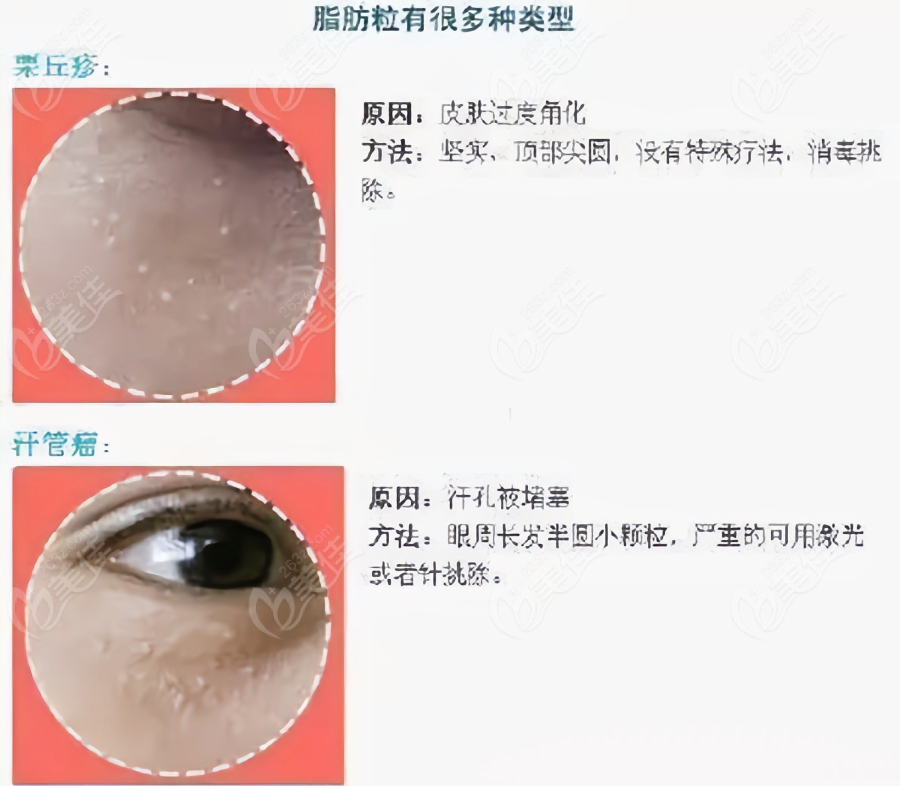 眼部汗管瘤的根治方法图片
