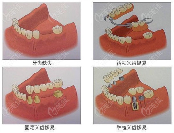 济南镶牙的几种方式类型