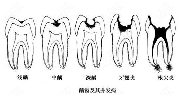 蛀牙引起的牙髓炎的图