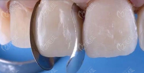 树脂修复解决牙缝大