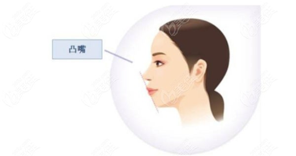 嘴凸分骨性和牙性