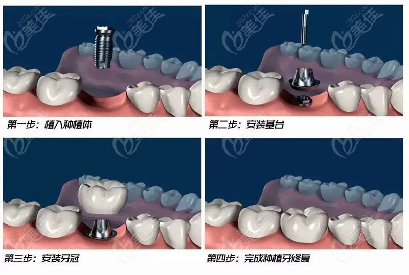 种植牙手术流程及步骤了解下