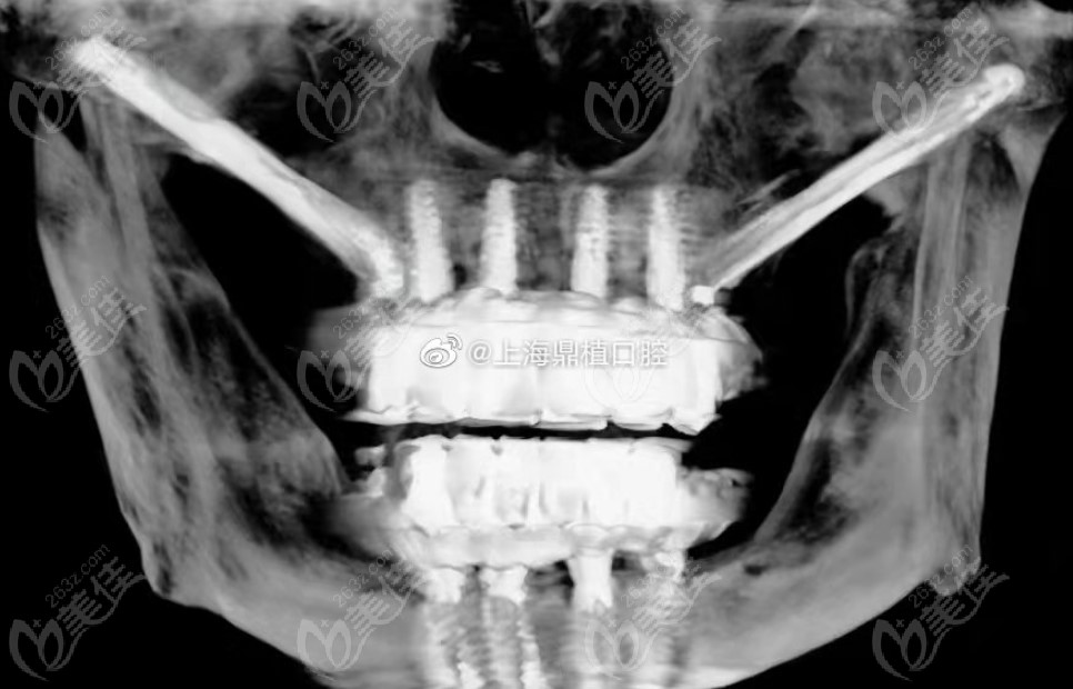 穿颧种植牙的CT照