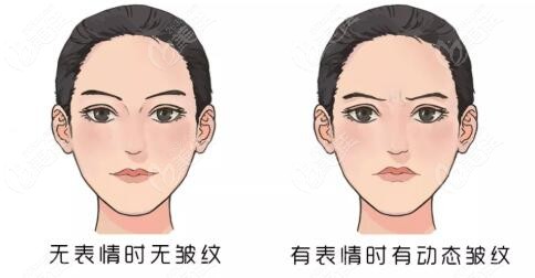 眉毛间的川字纹