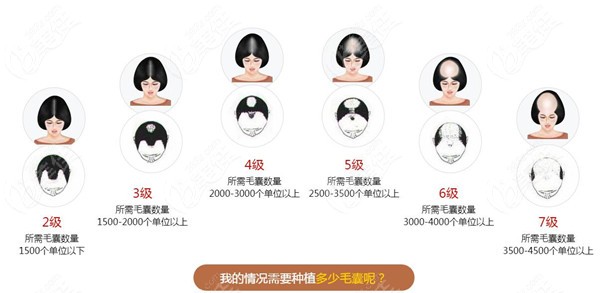 脱发1-7级程度图片