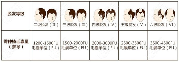 成都中年男士植发3000毛囊单位的费用是多少