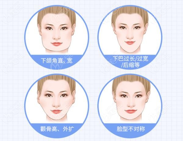 磨骨手术可以改善哪些脸型