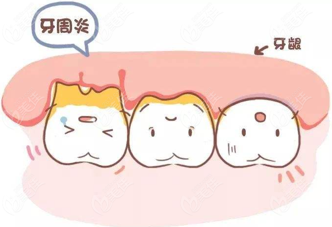 牙周病发展的四个阶段