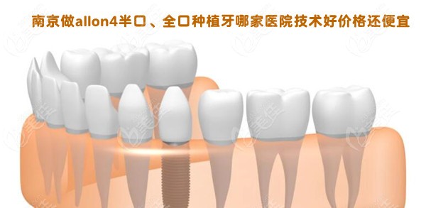 南京做allon4半口、全口种植牙哪家医院技术好价格还便宜