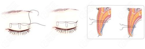双眼皮手术缝合过程