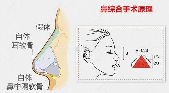 鼻综合手术原理