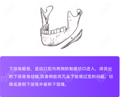 武汉亚韩下颌角截骨术