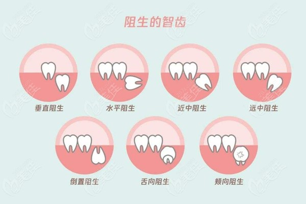阻生牙的分类图片图片