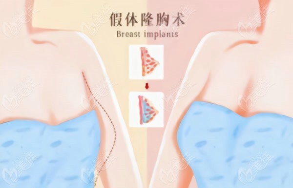 假体隆胸前后对比照片