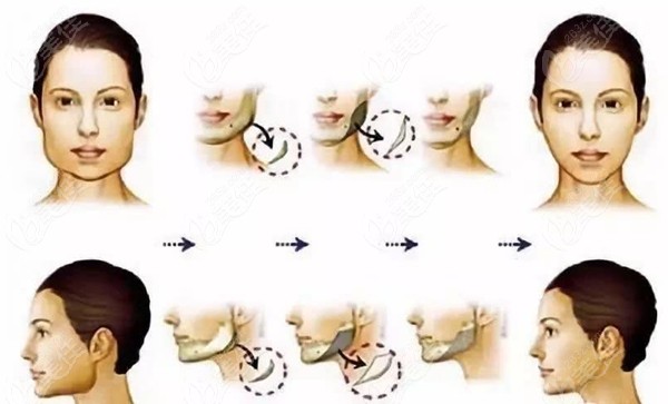 下颌角削骨需要考虑正面和侧面的脸型