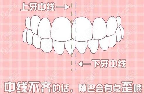 牙齿中线偏移多少毫米算正常